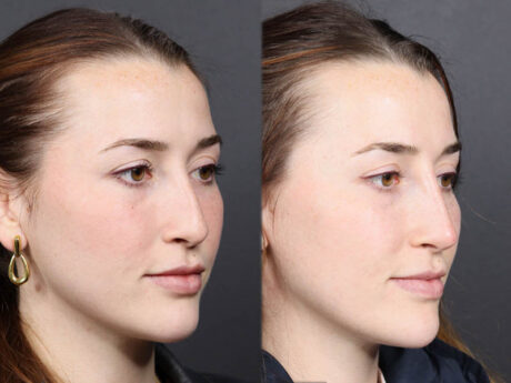 Liquid Rhinoplasty case #11774