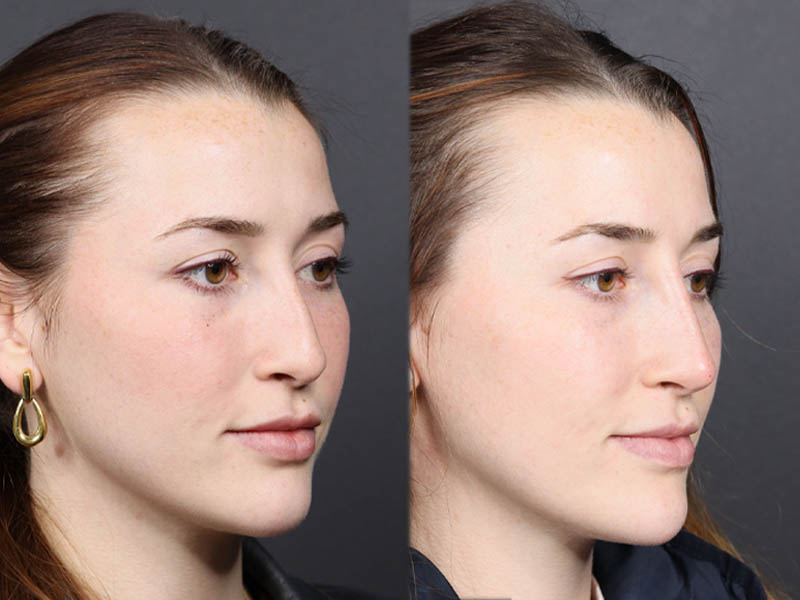 Liquid Rhinoplasty case #11774