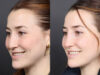 Liquid Rhinoplasty case #11774 slider thumbnail