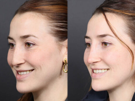 Liquid Rhinoplasty case #11774