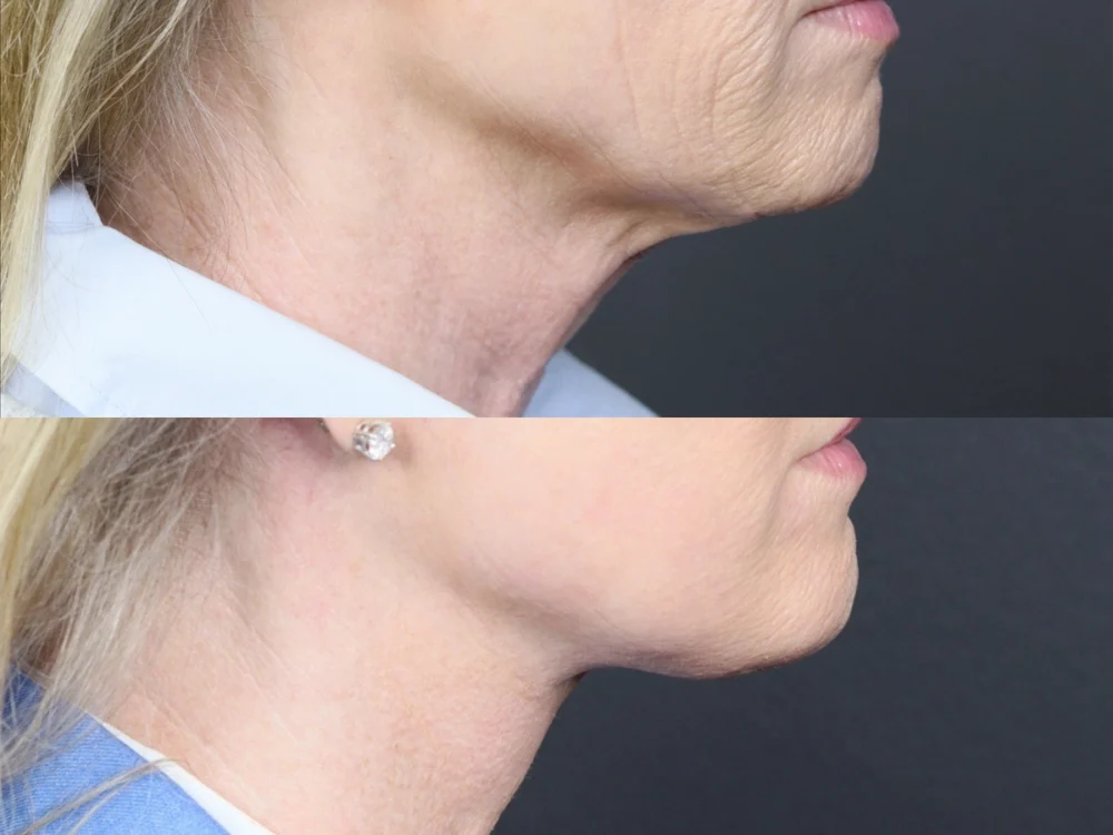 Necklift case #11853