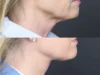 Necklift case #11853 slider thumbnail