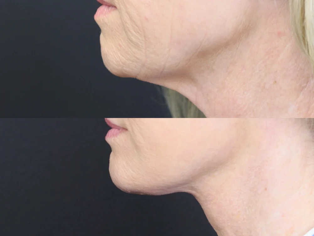 Necklift case #11853