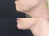 Necklift case #11853 slider thumbnail