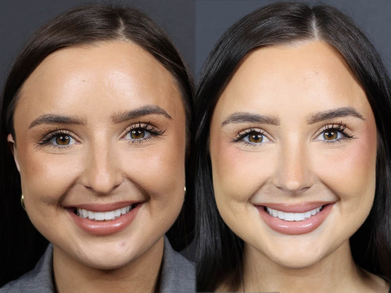 Rhinoplasty case #11858