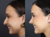 Rhinoplasty case #11858 slider thumbnail