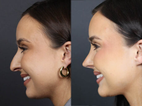 Rhinoplasty case #11858