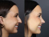 Rhinoplasty case #11858 slider thumbnail