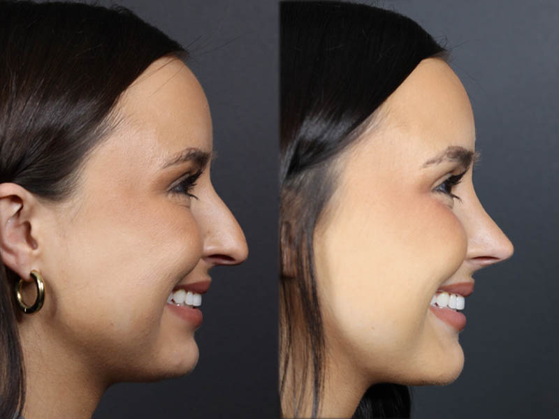 Rhinoplasty case #11858