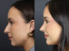 Rhinoplasty case #11858 slider thumbnail