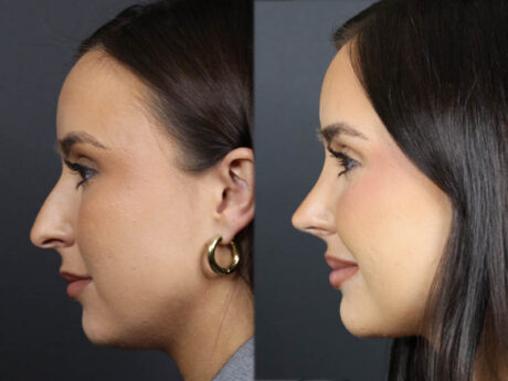 Rhinoplasty case #11858