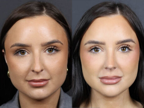 Rhinoplasty case #11858