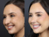 Rhinoplasty case #11858 slider thumbnail
