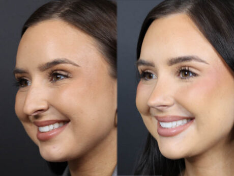 Rhinoplasty case #11858