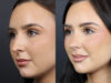 Rhinoplasty case #11858 slider thumbnail