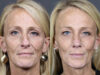 Rhinoplasty case #11866 slider thumbnail