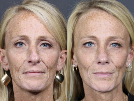 Rhinoplasty case #11866