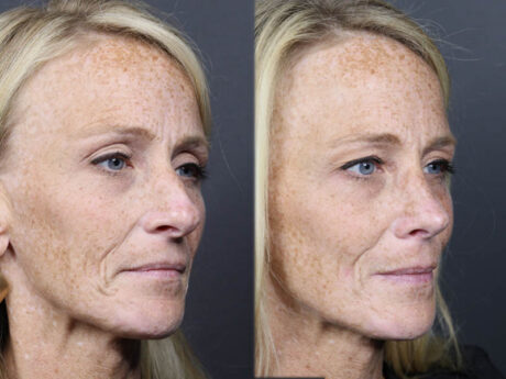 Rhinoplasty case #11866