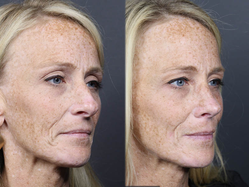 Rhinoplasty case #11866