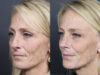 Rhinoplasty case #11866 slider thumbnail