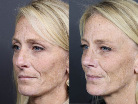 Rhinoplasty case #11866