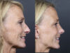 Rhinoplasty case #11866 slider thumbnail