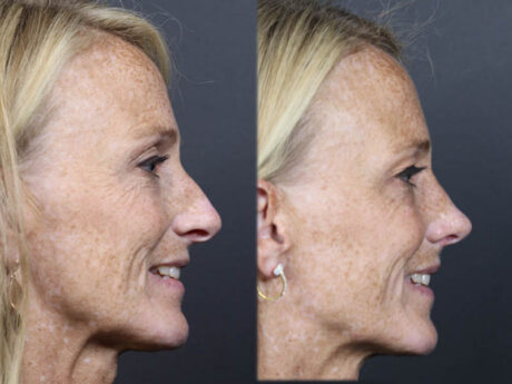 Rhinoplasty case #11866