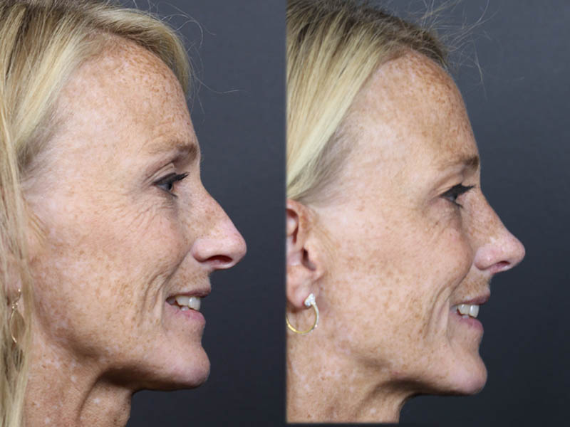 Rhinoplasty case #11866