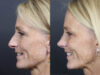 Rhinoplasty case #11866 slider thumbnail