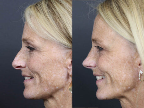 Rhinoplasty case #11866