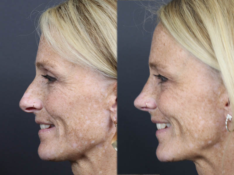 Rhinoplasty case #11866