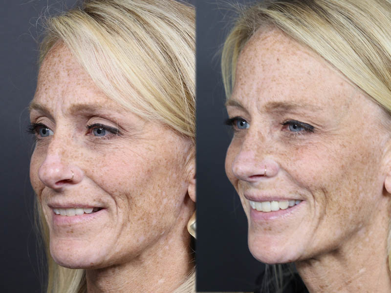 Rhinoplasty case #11866