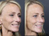 Rhinoplasty case #11866 slider thumbnail