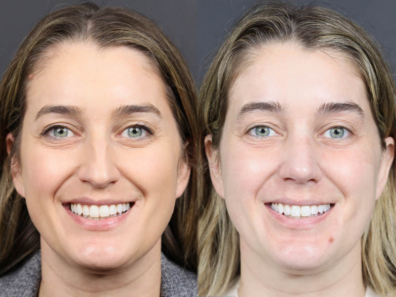 Rhinoplasty case #11874