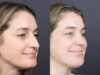 Rhinoplasty case #11874 slider thumbnail