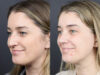 Rhinoplasty case #11874 slider thumbnail