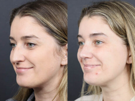 Rhinoplasty case #11874