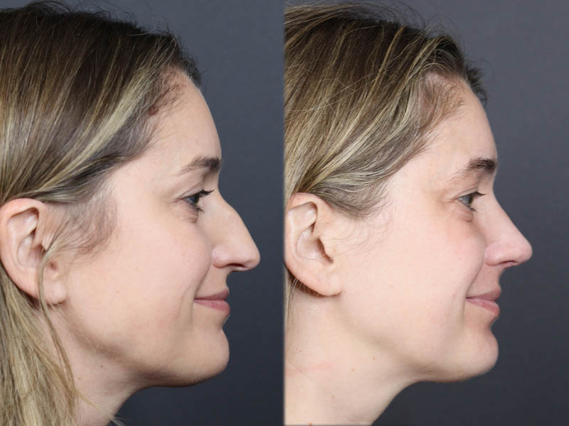 Rhinoplasty case #11874