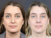 Rhinoplasty case #11874 slider thumbnail