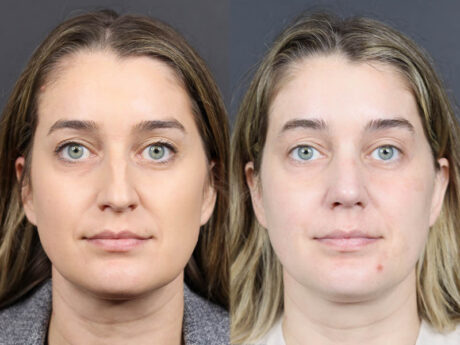 Rhinoplasty case #11874