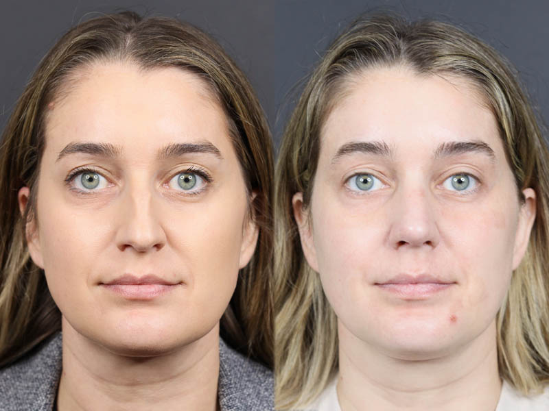 Rhinoplasty case #11874