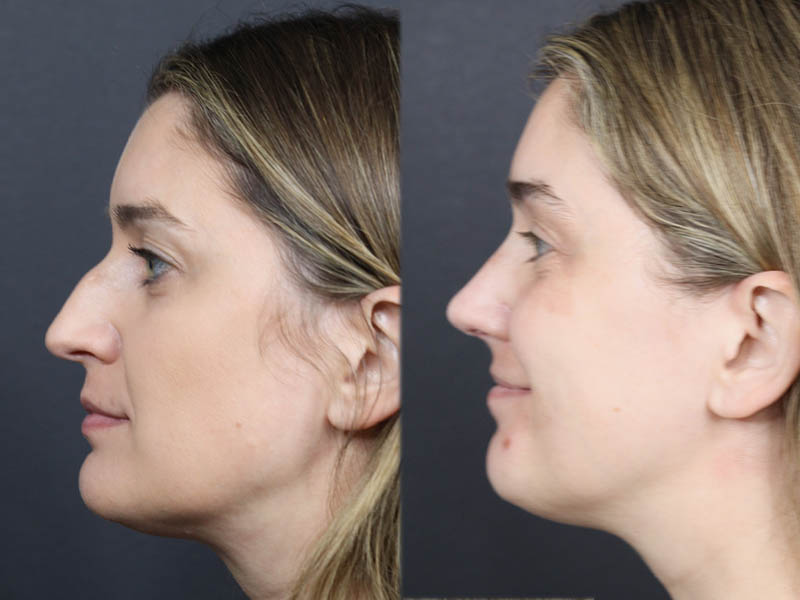 Rhinoplasty case #11874