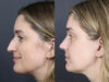 Rhinoplasty case #11874 slider thumbnail