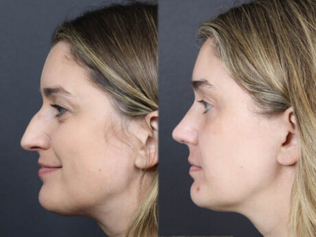 Rhinoplasty case #11874