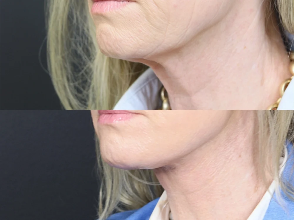Necklift case #11853