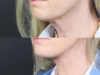 Necklift case #11853 slider thumbnail