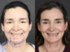 Facelift case #12139 slider thumbnail