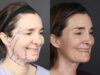 Facelift case #12139 slider thumbnail