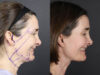 Facelift case #12139 slider thumbnail
