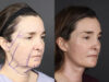 Facelift case #12139 slider thumbnail